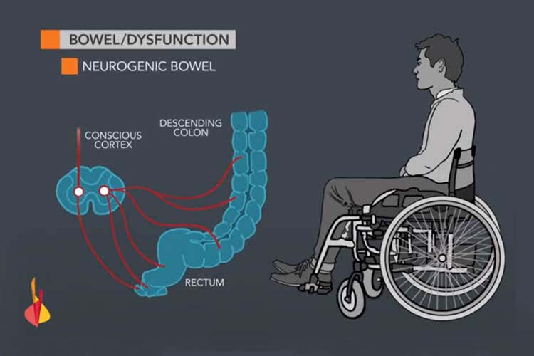 Bowel Management