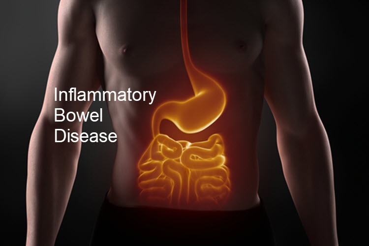 Inflammatory Bowel Disease